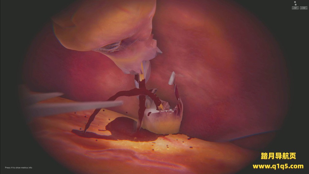 Oculus Quest 游戏《手术VR》SurgicaVR